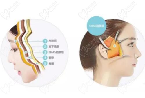 無痕筋膜提升和線提升根本不是一回事！四大核心區(qū)別解析