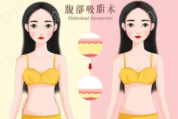 哈爾濱羽禪醫(yī)美楊宇梓做腰腹環(huán)吸怎么樣